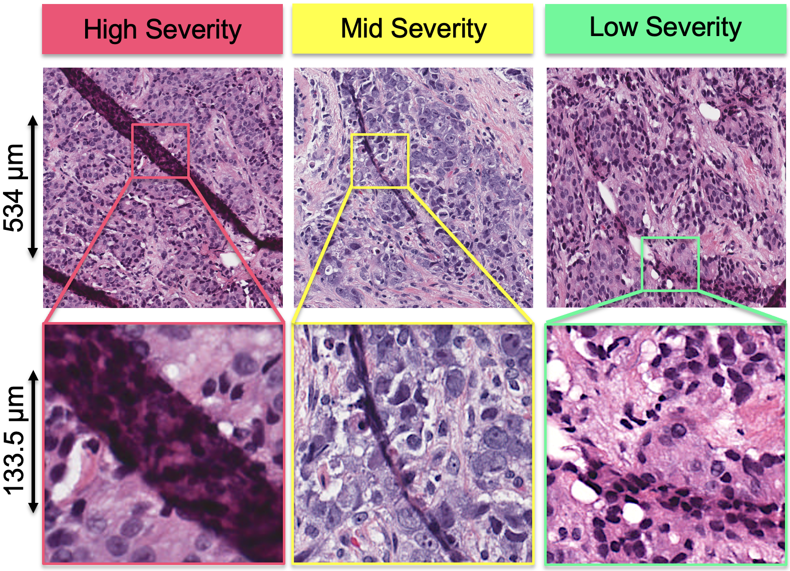Tissue Artifact Segmentation and Severity Assessment for Automatic Analysis using Whole Slide Image