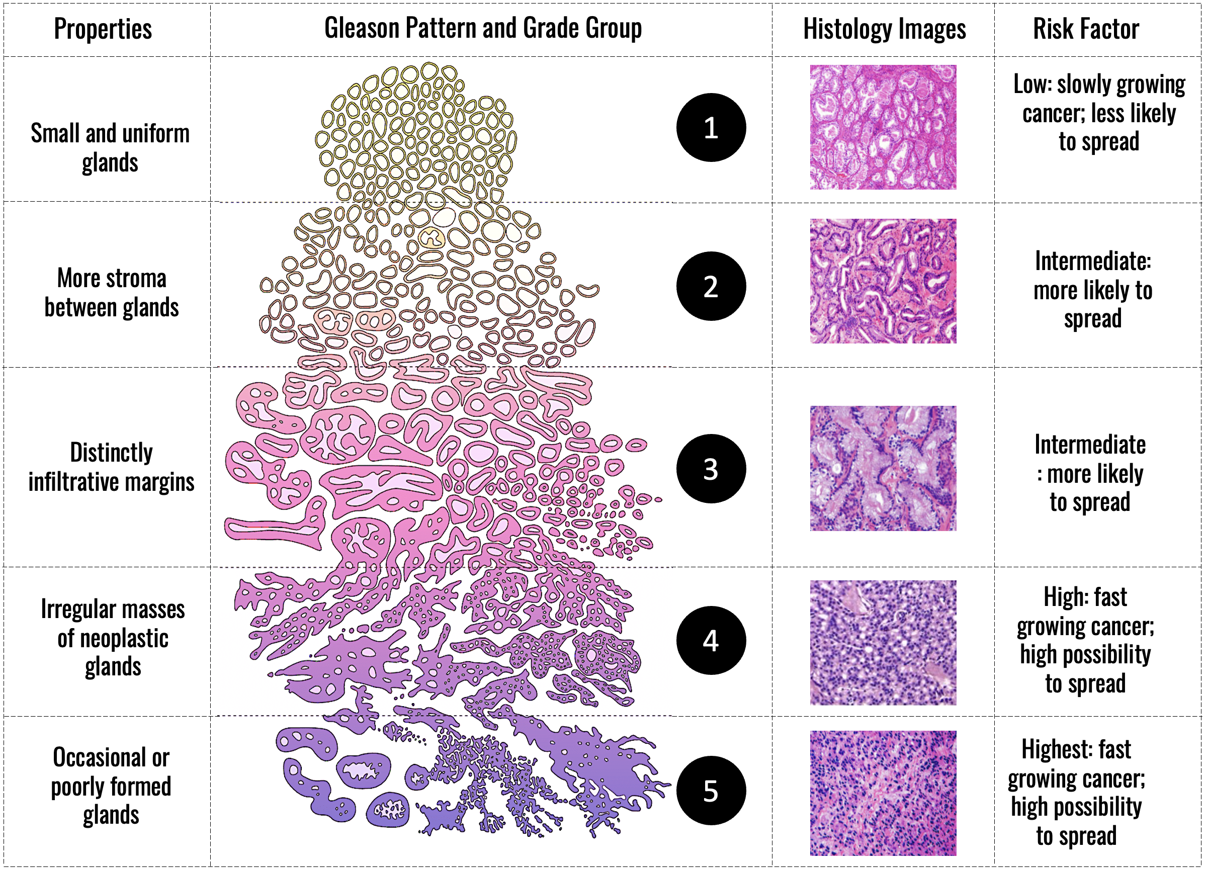 Gleason Grading of Prostate Cancer