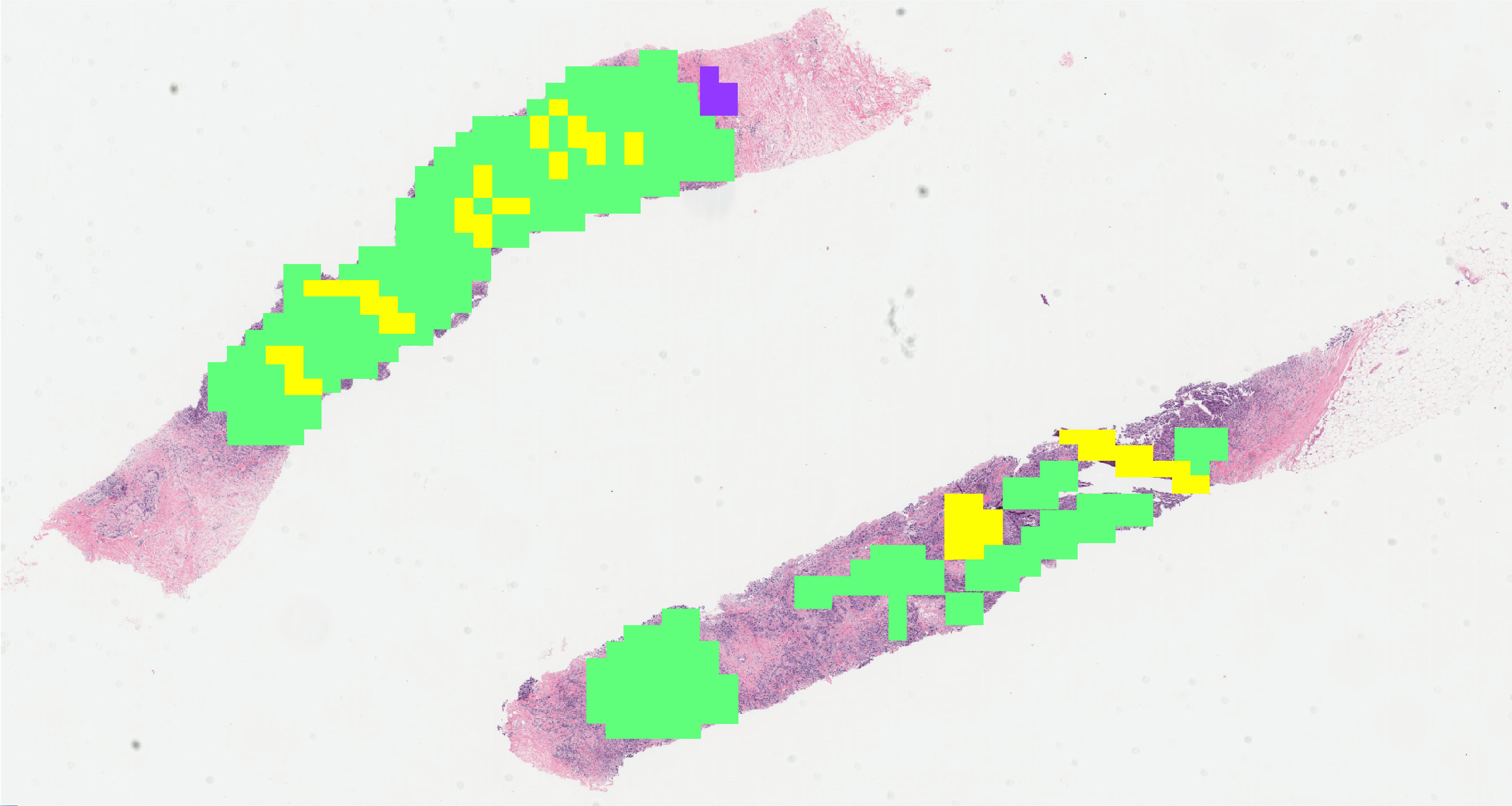 HER2 Grading of Breast Cancer Patients