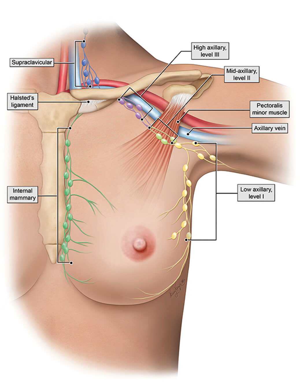 Automated Diganosis Pipeline for Breast Cancer Metastasis Assessment