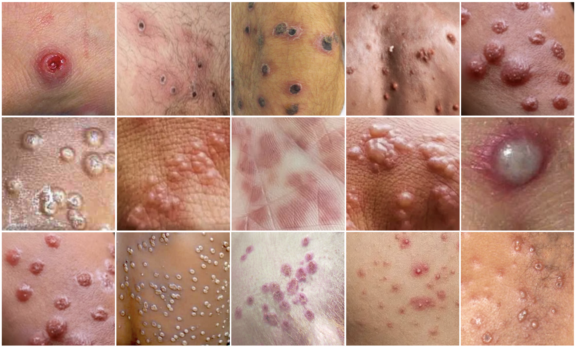 Monkeypox skin image dataset (MPox-Vision)